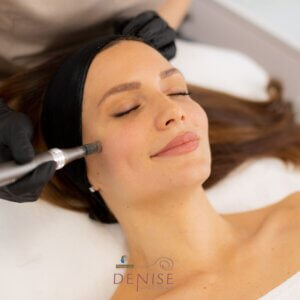 Needling Viso